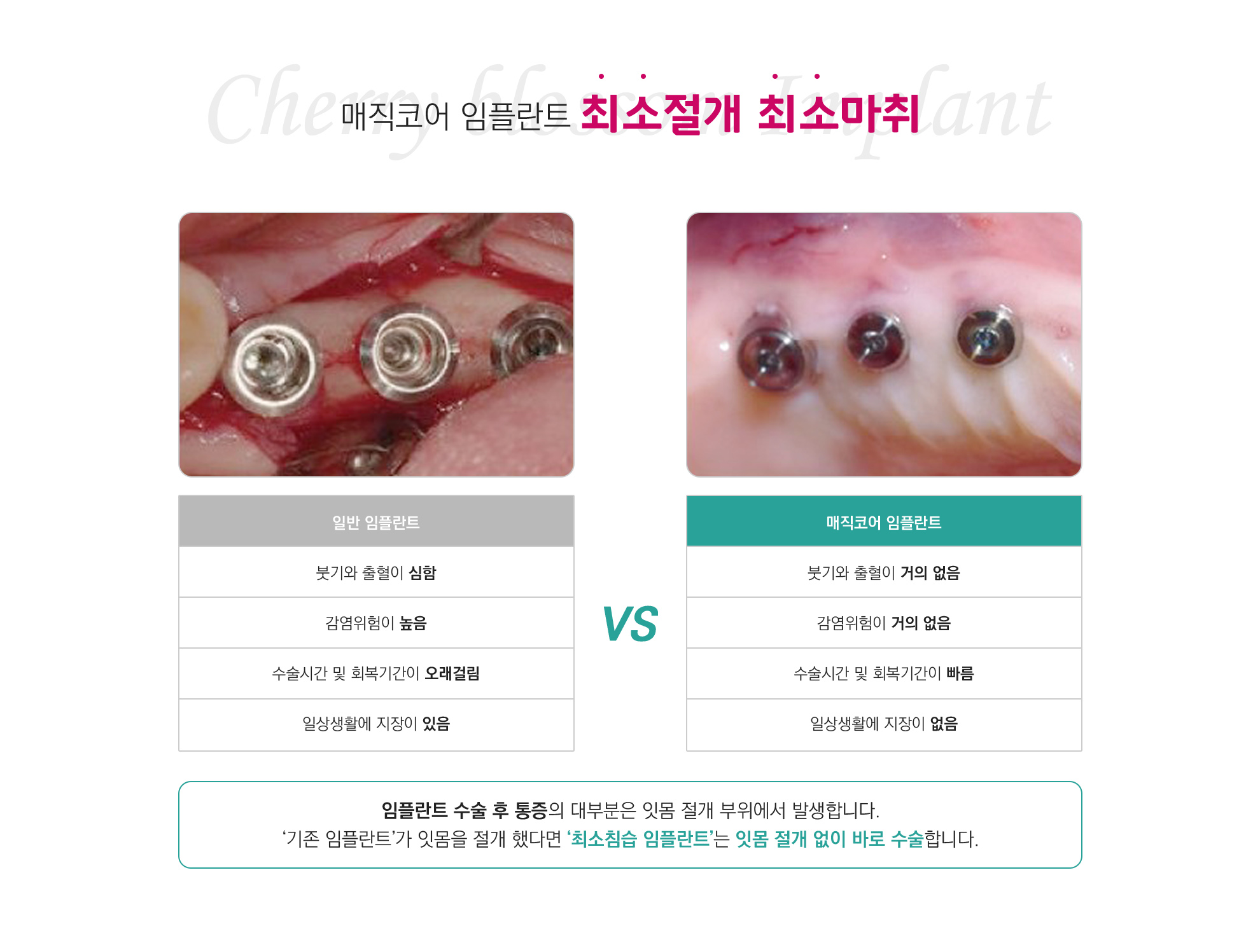 매직코어 임플란트 최소절개 최소마취